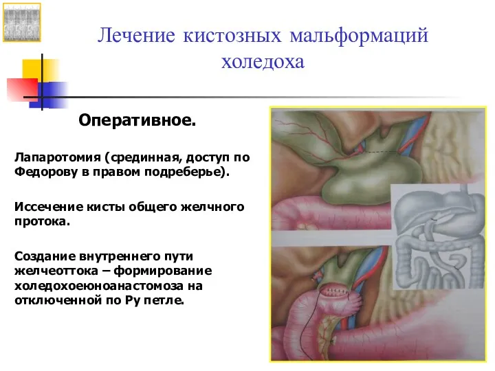 Лечение кистозных мальформаций холедоха Оперативное. Лапаротомия (срединная, доступ по Федорову