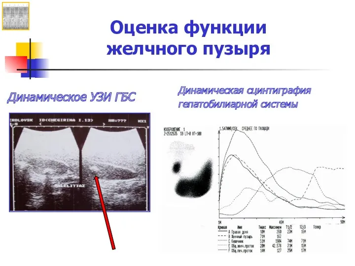 Оценка функции желчного пузыря Динамическое УЗИ ГБС Динамическая сцинтиграфия гепатобилиарной системы