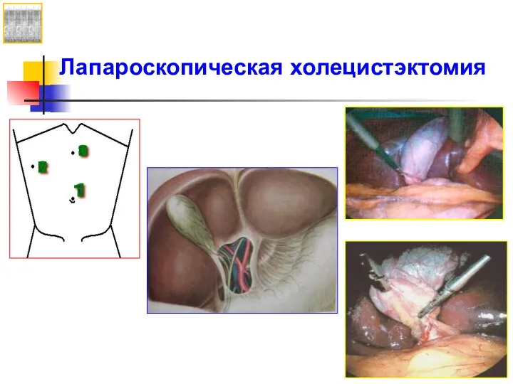 Лапароскопическая холецистэктомия 1 2 3