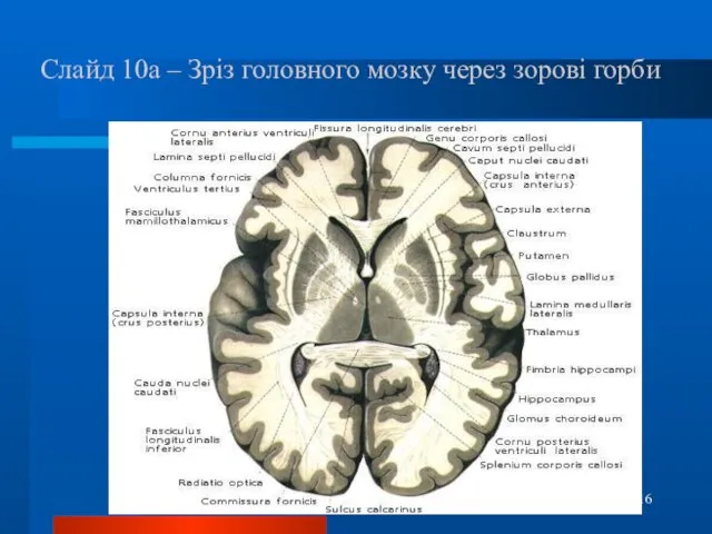 Слайд 10а – Зріз головного мозку через зорові горби