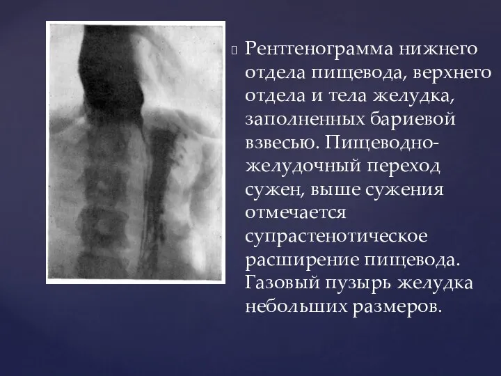 Рентгенограмма нижнего отдела пищевода, верхнего отдела и тела желудка, заполненных