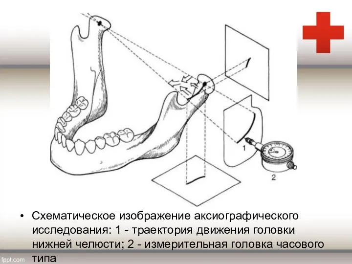 Схематическое изображение аксиографического исследования: 1 - траектория движения головки нижней челюсти; 2 -