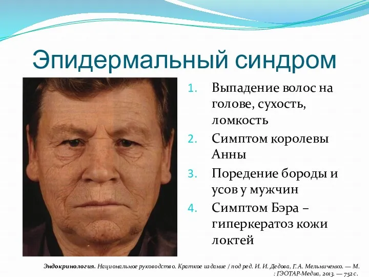 Эпидермальный синдром Выпадение волос на голове, сухость, ломкость Симптом королевы