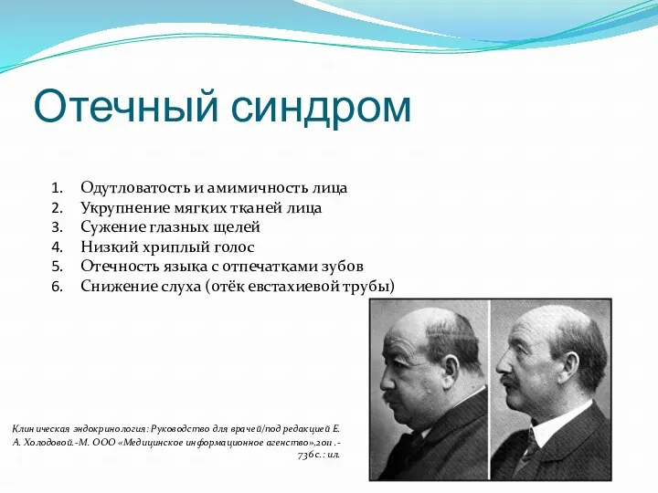 Отечный синдром Одутловатость и амимичность лица Укрупнение мягких тканей лица