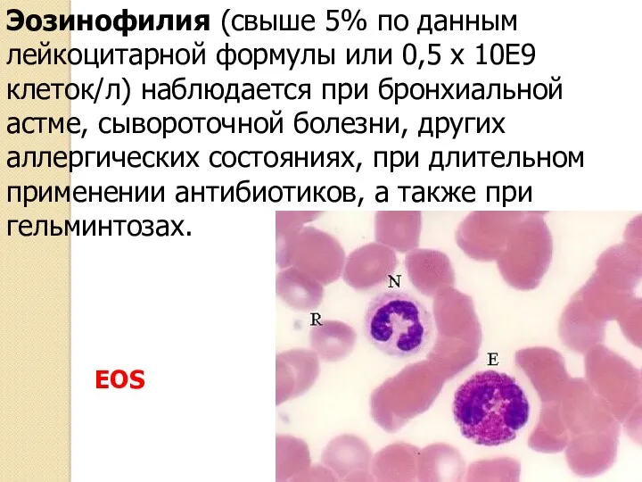 Эозинофилия (свыше 5% по данным лейкоцитарной формулы или 0,5 х 10Е9 клеток/л) наблюдается