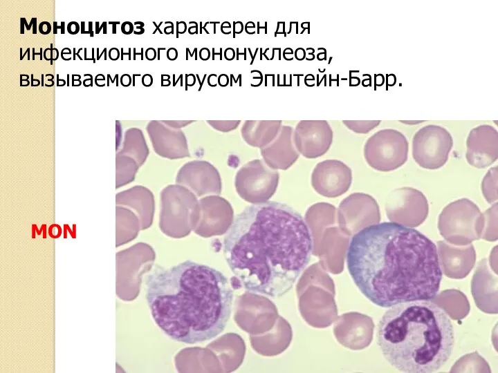 Моноцитоз характерен для инфекционного мононуклеоза, вызываемого вирусом Эпштейн-Барр. MON