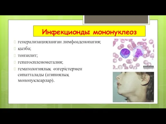 Инфекционды мононуклеоз генерализацияланған лимфоаденопатия; қызба; тонзилит; гепатоспленомегалия; гематологиялық өзгерістермен сипатталады (атипиялық мононуклеарлар).