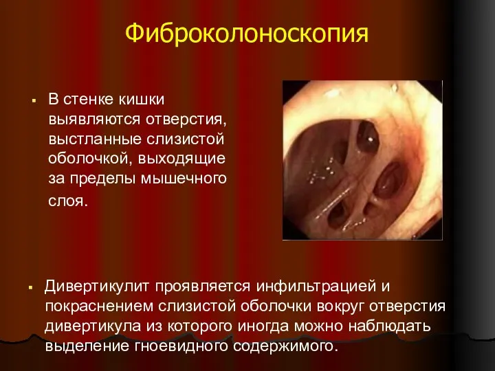 Фиброколоноскопия В стенке кишки выявляются отверстия, выстланные слизистой оболочкой, выходящие