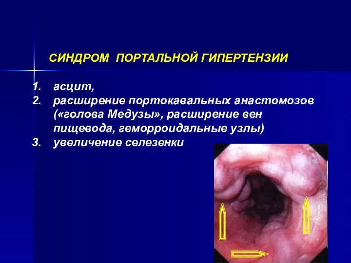 СИНДРОМ ПОРТАЛЬНОЙ ГИПЕРТЕНЗИИ асцит, расширение портокавальных анастомозов («голова Медузы», расширение вен пищевода, геморроидальные узлы) увеличение селезенки