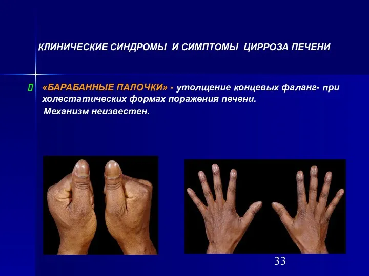 «БАРАБАННЫЕ ПАЛОЧКИ» - утолщение концевых фаланг- при холестатических формах поражения