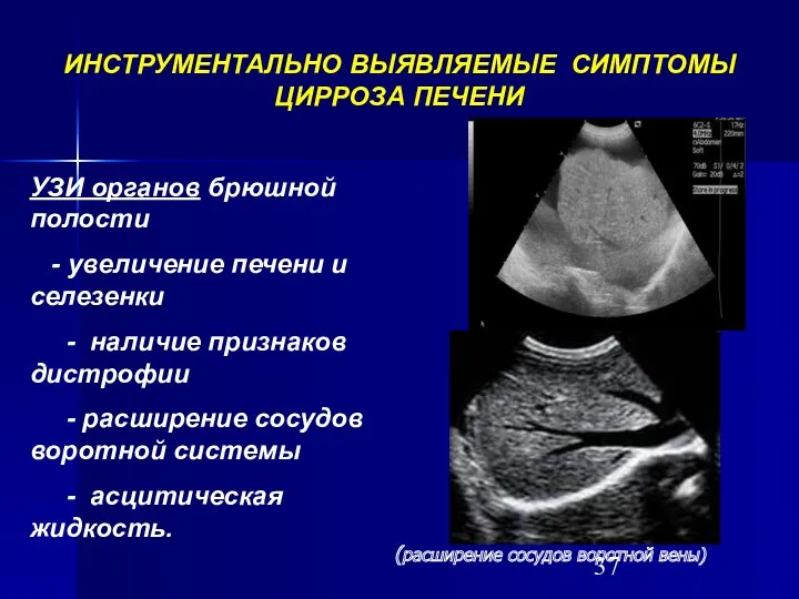 ИНСТРУМЕНТАЛЬНО ВЫЯВЛЯЕМЫЕ СИМПТОМЫ ЦИРРОЗА ПЕЧЕНИ УЗИ органов брюшной полости -