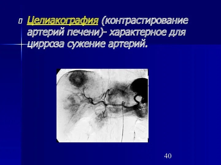 Целиакография (контрастирование артерий печени)- характерное для цирроза сужение артерий.