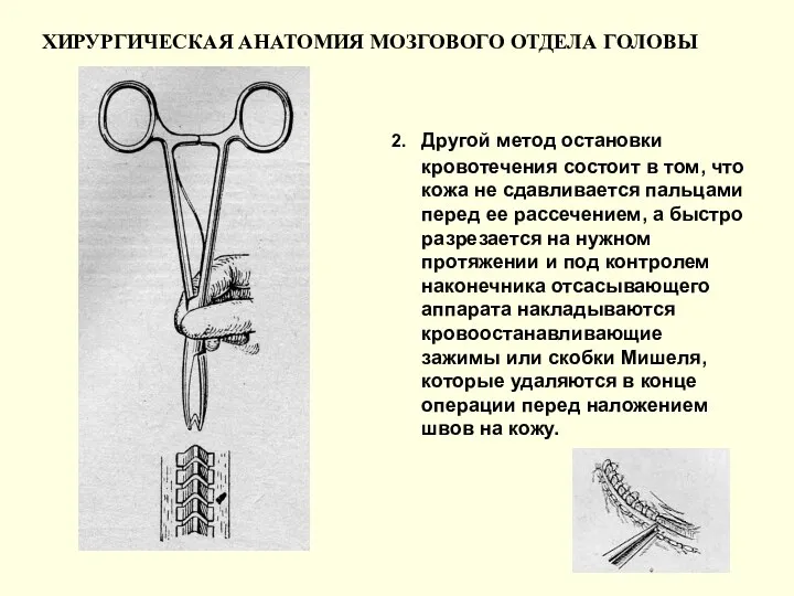 ХИРУРГИЧЕСКАЯ АНАТОМИЯ МОЗГОВОГО ОТДЕЛА ГОЛОВЫ 2. Другой метод остановки кровотечения