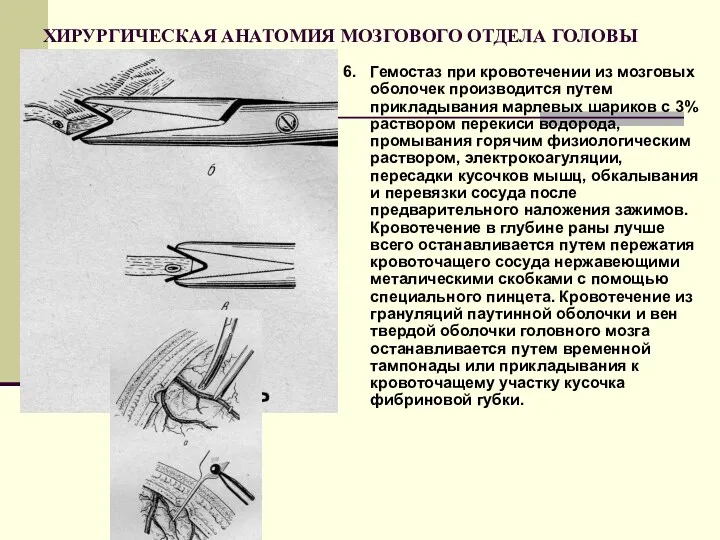 ХИРУРГИЧЕСКАЯ АНАТОМИЯ МОЗГОВОГО ОТДЕЛА ГОЛОВЫ 6. Гемостаз при кровотечении из