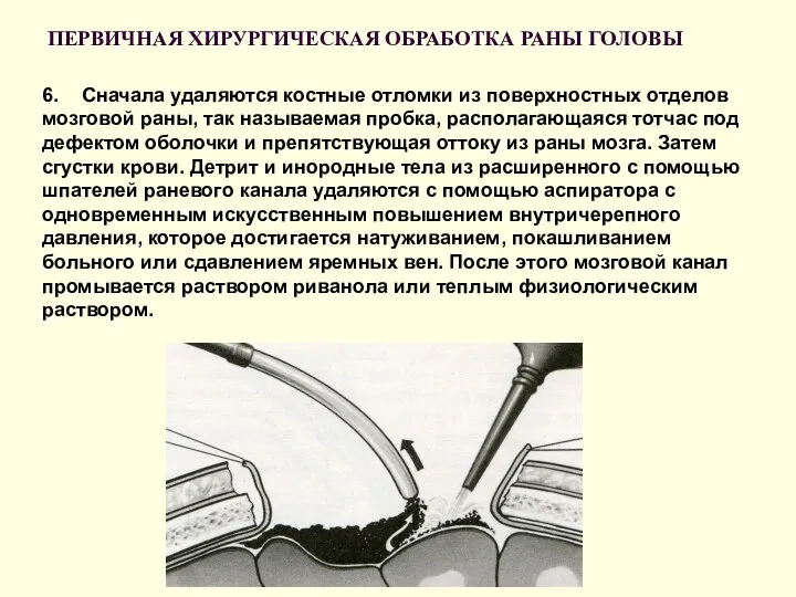 ПЕРВИЧНАЯ ХИРУРГИЧЕСКАЯ ОБРАБОТКА РАНЫ ГОЛОВЫ 6. Сначала удаляются костные отломки