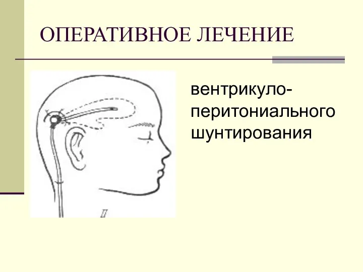 ОПЕРАТИВНОЕ ЛЕЧЕНИЕ вентрикуло- перитониального шунтирования