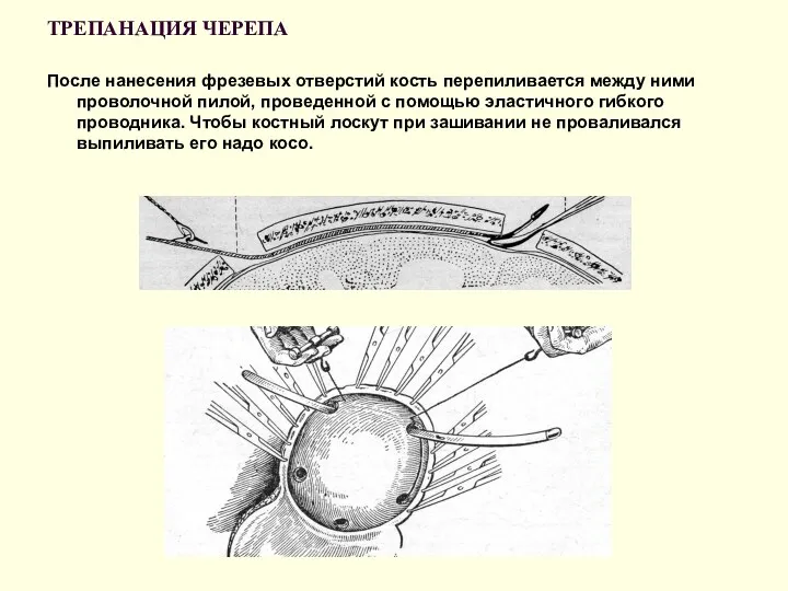 ТРЕПАНАЦИЯ ЧЕРЕПА После нанесения фрезевых отверстий кость перепиливается между ними