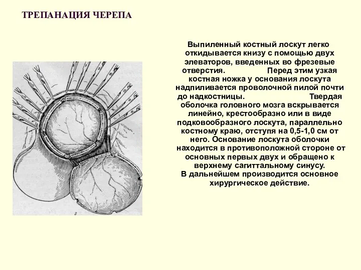 ТРЕПАНАЦИЯ ЧЕРЕПА Выпиленный костный лоскут легко откидывается книзу с помощью