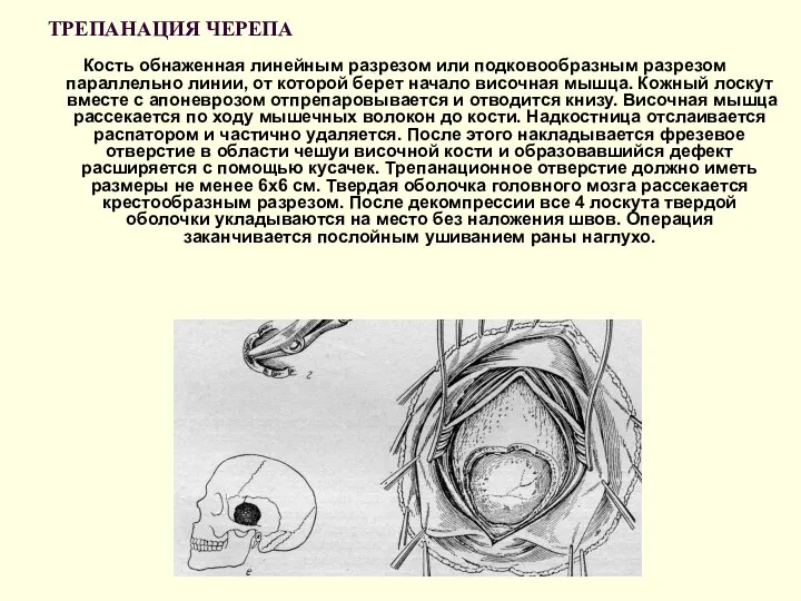 ТРЕПАНАЦИЯ ЧЕРЕПА Кость обнаженная линейным разрезом или подковообразным разрезом параллельно
