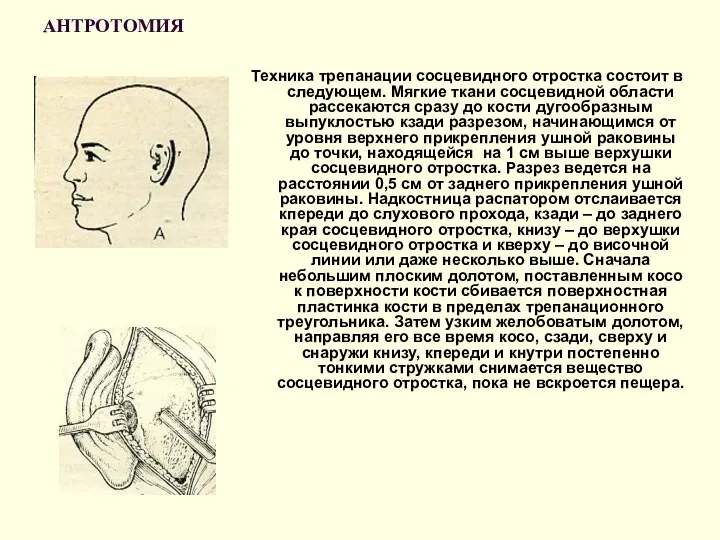 АНТРОТОМИЯ Техника трепанации сосцевидного отростка состоит в следующем. Мягкие ткани