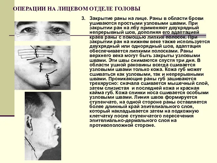 ОПЕРАЦИИ НА ЛИЦЕВОМ ОТДЕЛЕ ГОЛОВЫ 3. Закрытие раны на лице.