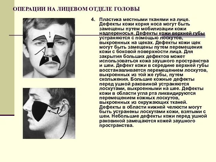 ОПЕРАЦИИ НА ЛИЦЕВОМ ОТДЕЛЕ ГОЛОВЫ 4. Пластика местными тканями на