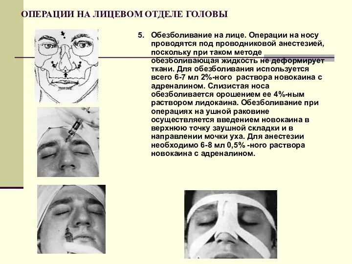 ОПЕРАЦИИ НА ЛИЦЕВОМ ОТДЕЛЕ ГОЛОВЫ 5. Обезболивание на лице. Операции