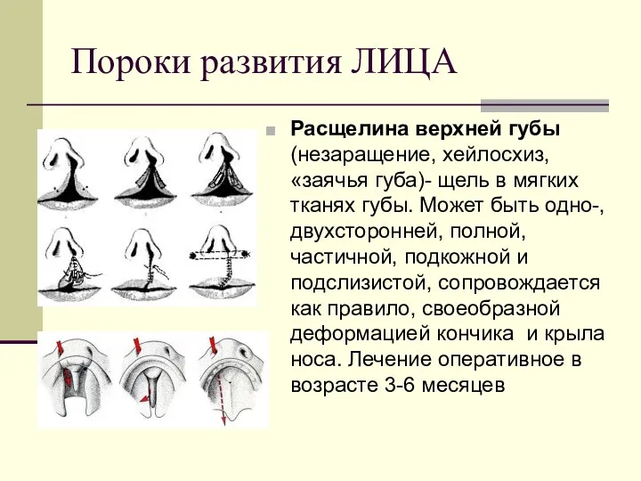 Пороки развития ЛИЦА Расщелина верхней губы (незаращение, хейлосхиз, «заячья губа)-