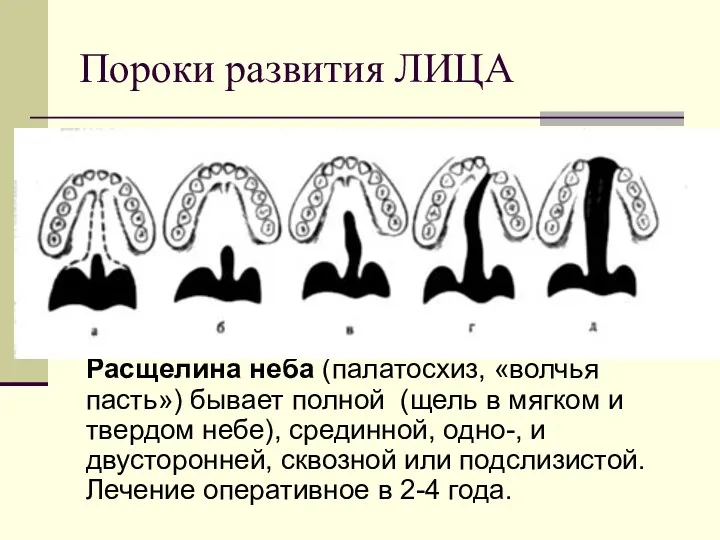 Пороки развития ЛИЦА Расщелина неба (палатосхиз, «волчья пасть») бывает полной