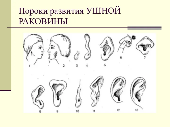 Пороки развития УШНОЙ РАКОВИНЫ