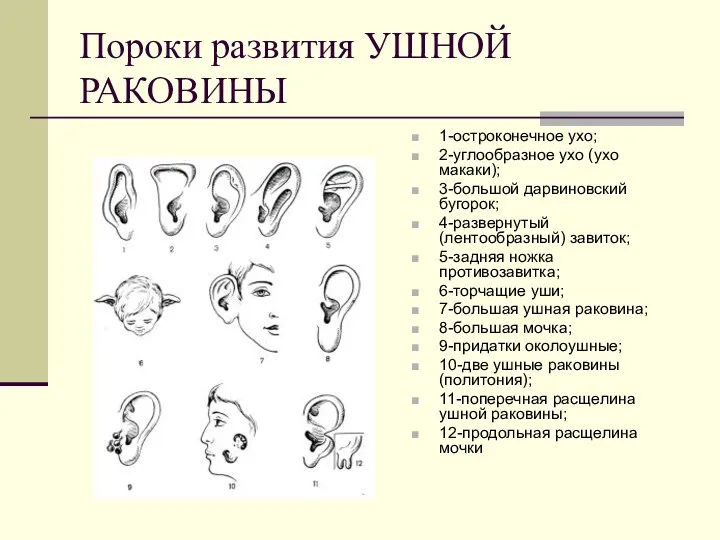 Пороки развития УШНОЙ РАКОВИНЫ 1-остроконечное ухо; 2-углообразное ухо (ухо макаки);