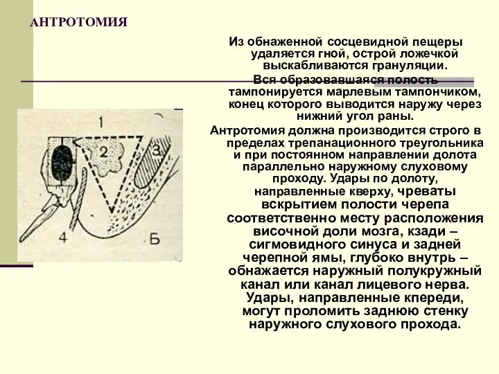 АНТРОТОМИЯ Из обнаженной сосцевидной пещеры удаляется гной, острой ложечкой выскабливаются