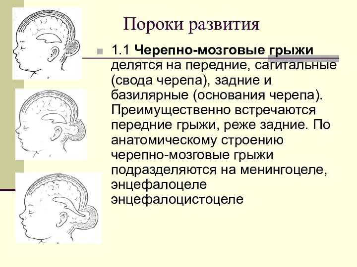 Пороки развития 1.1 Черепно-мозговые грыжи делятся на передние, сагитальные (свода