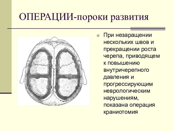 ОПЕРАЦИИ-пороки развития При незаращении нескольких швов и прекращении роста черепа,