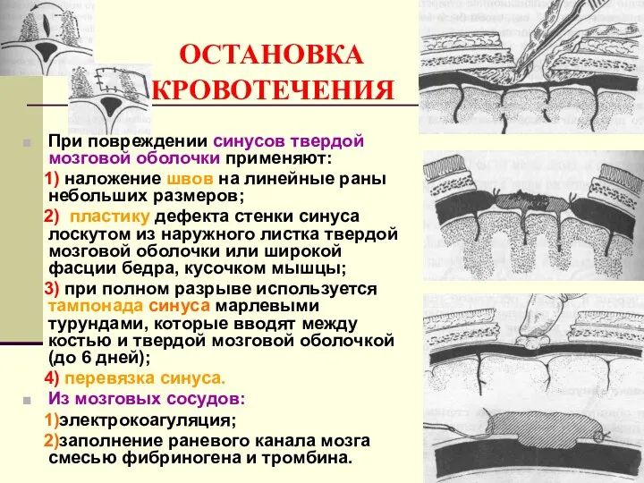 ОСТАНОВКА КРОВОТЕЧЕНИЯ При повреждении синусов твердой мозговой оболочки применяют: 1)