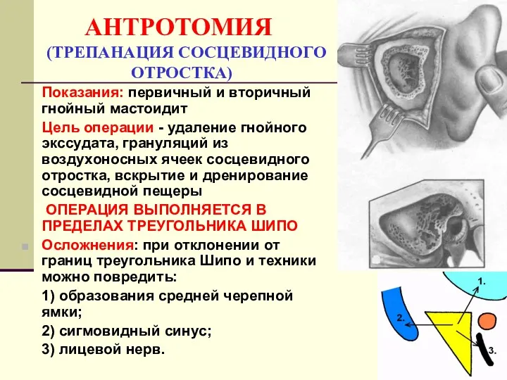 АНТРОТОМИЯ (ТРЕПАНАЦИЯ СОСЦЕВИДНОГО ОТРОСТКА) Показания: первичный и вторичный гнойный мастоидит