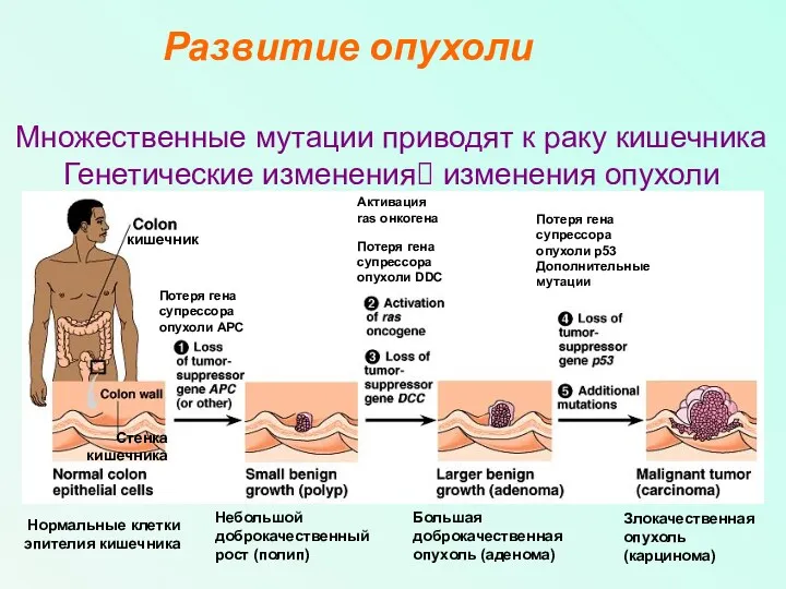 Множественные мутации приводят к раку кишечника Генетические изменения? изменения опухоли Развитие опухоли