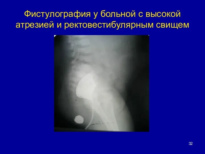 Фистулография у больной с высокой атрезией и ректовестибулярным свищем