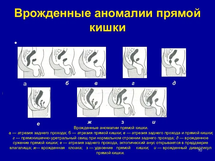 Врожденные аномалии прямой кишки а i Врожденные аномалии прямой кишки.