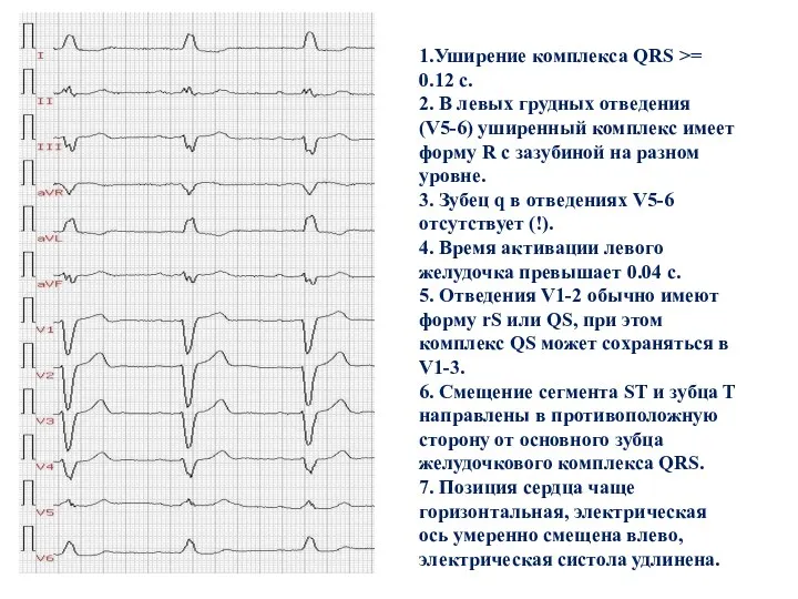 1.Уширение комплекса QRS >= 0.12 c. 2. В левых грудных