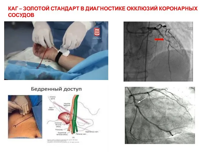 КАГ – ЗОЛОТОЙ СТАНДАРТ В ДИАГНОСТИКЕ ОККЛЮЗИЙ КОРОНАРНЫХ СОСУДОВ