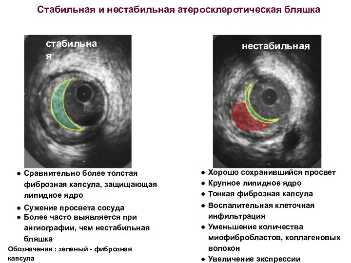 Стабильная и нестабильная атеросклеротическая бляшка Хорошо сохранившийся просвет Крупное липидное