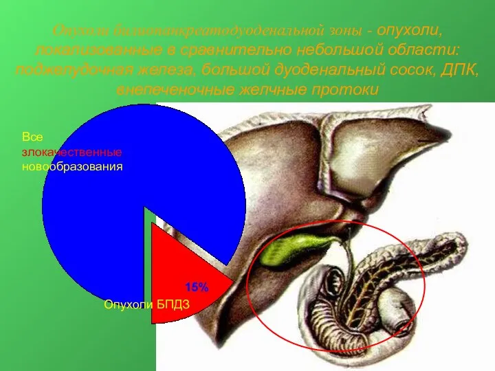 Опухоли билиопанкреатодуоденальной зоны - опухоли, локализованные в сравнительно небольшой области: