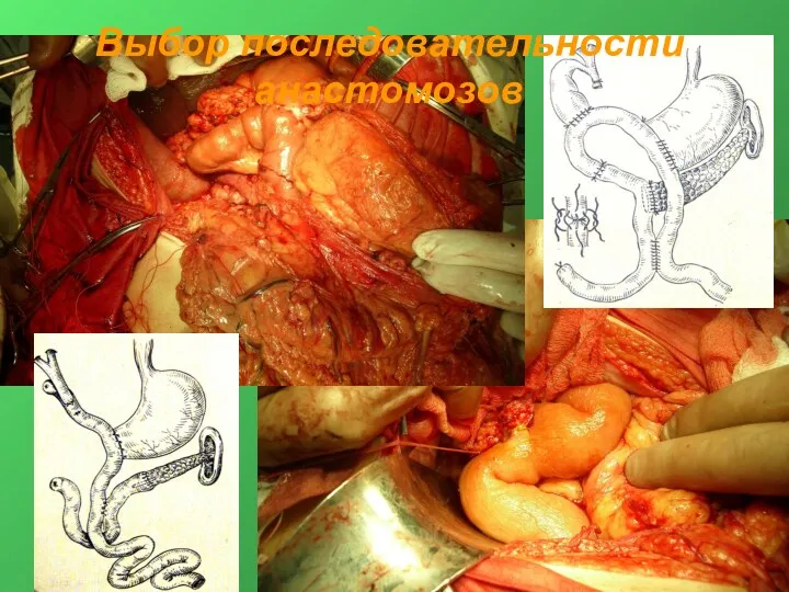 Выбор последовательности анастомозов