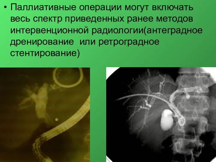 Паллиативные операции могут включать весь спектр приведенных ранее методов интервенционной радиологии(антеградное дренирование или ретроградное стентирование)