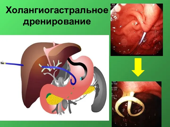 Холангиогастральное дренирование