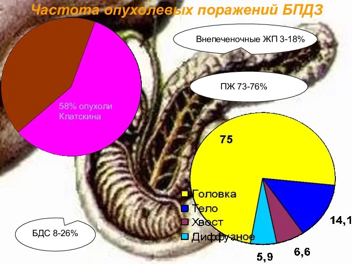 Частота опухолевых поражений БПДЗ