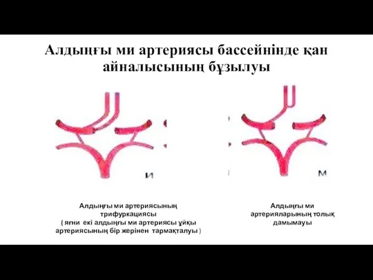 Алдыңғы ми артериясы бассейнінде қан айналысының бұзылуы Алдыңғы ми артериясының