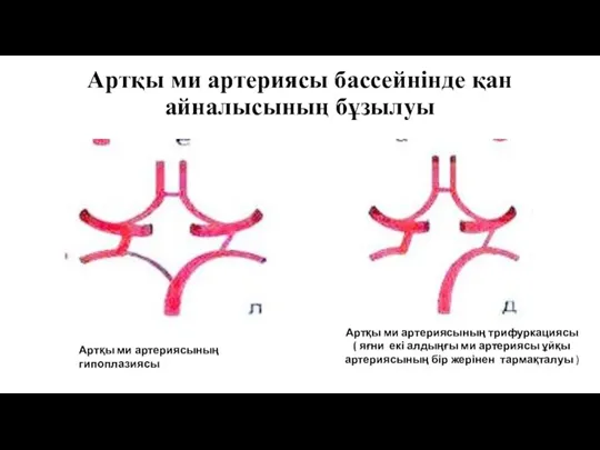 Артқы ми артериясы бассейнінде қан айналысының бұзылуы Артқы ми артериясының