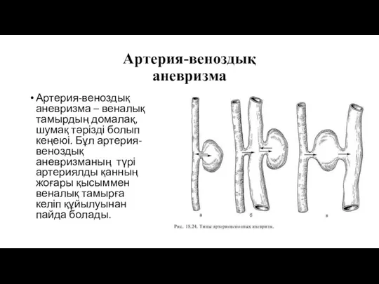 Артерия-веноздық аневризма Артерия-веноздық аневризма – веналық тамырдың домалақ, шумақ тәрізді